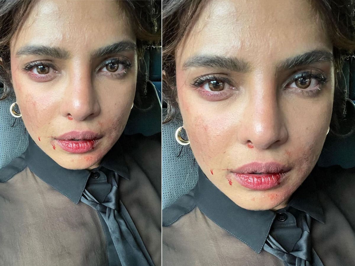 Priyanka Chopra Face Injury: What Happened To Her On The Sets of 'Citadel'